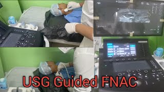 FNAC  Fine Niddle Aspiration Cytology  USG Guided FNAC  Procedure [upl. by Jamima]