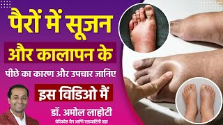 Leg Swelling amp Varicose Veins Your Treatment Options Explained By Dr Amol Lahoti [upl. by Felipa]