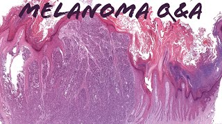 Melanoma Pathology QampA Discussion Immunostains Excision Specimens Nodal Nevus amp More [upl. by Casie]