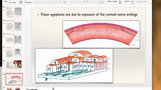 Bacterial Keratitis Part 1 [upl. by Nai778]