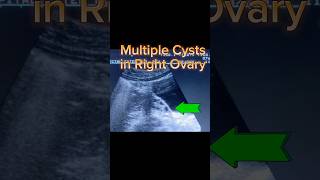 Polycystic Ovary ultrasound shorts [upl. by Petr558]