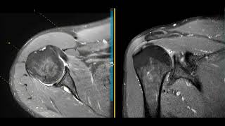 Biceps tendon rupture and SLAP tear [upl. by Solhcin658]