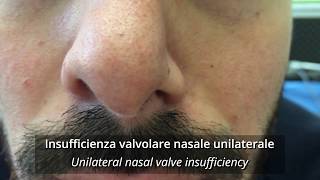 Insufficienza della valvola nasale dilatatore nasale vs cerotto nasale [upl. by Nevart]