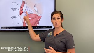 Treating Hip Bursitis  Regenerative options when traditional treatments stop working [upl. by Heater681]