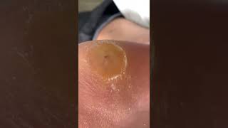 Foot scraping dead skin [upl. by Idhem]