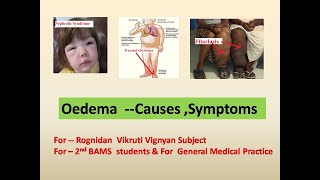 Mastering Oedema –Types amp Causes Symptoms l Oedema Pathology l Rognidan l 2nd BAMS l शोथ l Ayurveda [upl. by Hulbig342]