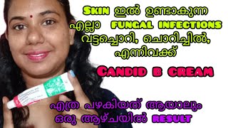 candid b cream for skin fungal infections  candid b ointment review malayalam [upl. by Etiam266]