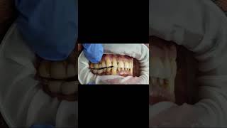 Lower implant molar bridge bite check with Bausch 40 micron articulating paper test shorts [upl. by Herve749]