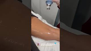 EXILIS ULTRA 360 [upl. by Nashner]