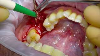 Removing an Unhealthy Dental Implant [upl. by Moffitt431]