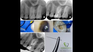 How to Break and Remove an Endodontic File  Dr Andrei Ionescu [upl. by Jae]