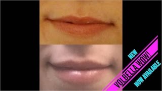 Juvederm Volbella Lip Filler Injection  Dr Rostami  Northern Virginia Washington DC Maryland [upl. by Nednarb]