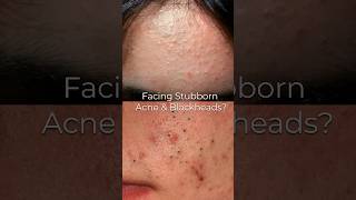 Single Serum to fight acne blackheads amp whiteheads😍 [upl. by Gorlicki]