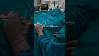 Angioplasty blockage ko theek karna angioplasty short video [upl. by Jerz]