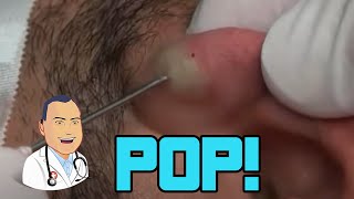 Penbrooks Ear Cyst Gets Popped [upl. by Gnud]