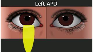 Relative Afferent Pupillary Defect  Medical Student Education [upl. by Ellenaj]