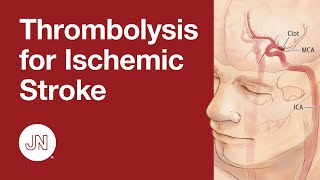 Thrombolysis Before Thrombectomy for Acute Ischemic Stroke [upl. by Aurita]