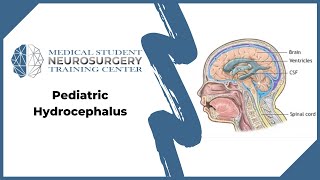 Pediatric Hydrocephalus [upl. by Natala]