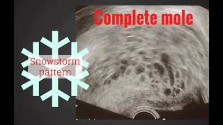 Topic 50 Gestational Trophoblastic Neoplasia [upl. by Brendin]