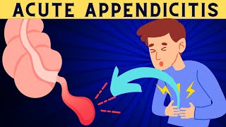 Acute Appendicitis Signs And Symptoms Risk Factors Diagnosis And Treatment [upl. by Blus138]