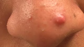 how to get rid of nose acne bumps tutorial [upl. by Sheaff931]