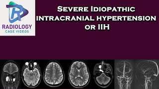 Severe Idiopathic intracranial hypertension or IIH [upl. by Lledniw75]