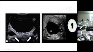 Posterior Urethral Valve [upl. by Woodley]