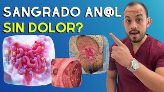 7 Causas de Sangrado Anorrectal SIN DOLOR Que No Conocias [upl. by Madian545]