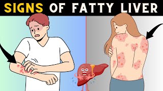 Dangerous Signs Of Fatty Liver  Dont Ignore [upl. by Yelrah53]