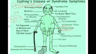 Cushing syndrome Dexamethasone suppression test explained [upl. by Oletha]