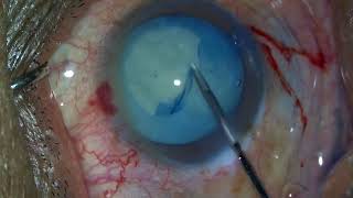 Phacoemulsification In Intumescent Cataract Vertical Chop Dr Sharath R Yajaman [upl. by Uolymme]