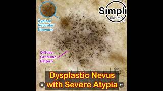 Severely Dysplastic Nevus Dermoscopy [upl. by Aniv696]