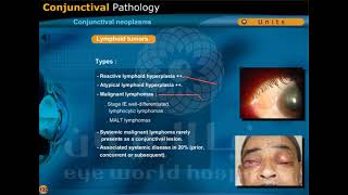 conjunctival neoplasms [upl. by Haeckel997]