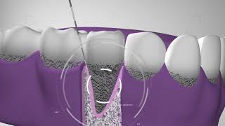 Curetaje higiene dental Te explicamos el procedimiento en Dentix [upl. by Gareth]