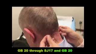 Acupuncture for Headache by GB20 Fengchi 针刺风池穴治头痛 [upl. by Uthrop]