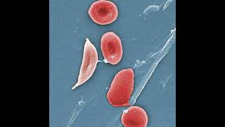 Sickle Cell Disease in the ED [upl. by Paule454]