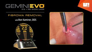 Fibroma Removal  Gemini EVO™ clinical cases [upl. by Abram958]