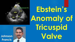 Ebsteins Anomaly of Tricuspid Valve [upl. by Erickson]