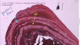 57P  Morphology of Thrombi and blood clots Review of heart blood flow path embolus [upl. by Riella998]