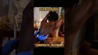 Chiropractic treatment for severe scoliosis chiropractic chiropractor [upl. by Anilos]