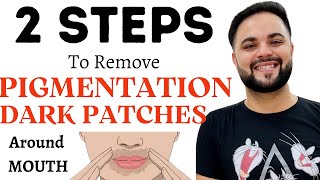 2 STEPS to Remove Pigmentation amp Dark Patches around Mouth [upl. by Tavie]