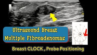 Breast Multiple Fibroadenomas  Positioning according to Breast Clock  Ultrasound [upl. by Eixor890]