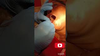 upper Third molar extraction [upl. by Ecnav162]