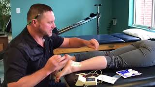 Iontophoresis in Physical Therapy [upl. by Innoc]