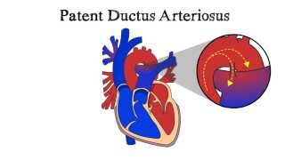 Patent Ductus Arteriosus PDA [upl. by Ardnayek]