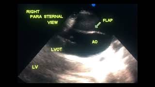 Asymptomatic dissection of aorta to drahmadmirdamadisiJSbA7GCDIDSLEpD [upl. by Surat]