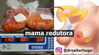 MAMOPLASTIA REDUTORA Cicatriz e Valor  Dr Valter Hugo [upl. by Desai678]