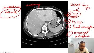 Hepatocellular carcinoma  Video No 4  NEET PG 2022  Radiology [upl. by Issor]