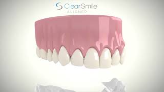 ClearSmile Aligner [upl. by Kenneth]