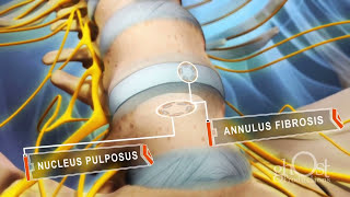 Herniated DISC Medical Animation  Ghost Medical Animation amp Surgical VR [upl. by Merriott]